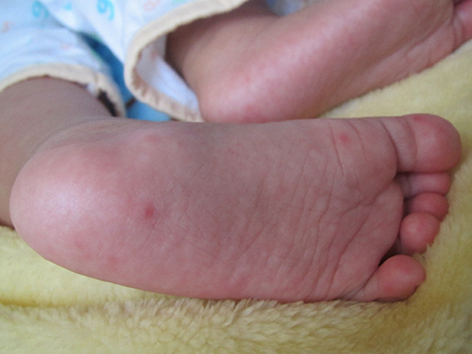 手足口初期疹子图片图片