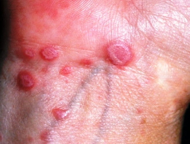 一期梅毒初期生殖器图片