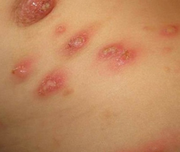 梅毒疹高清图片 一期图片