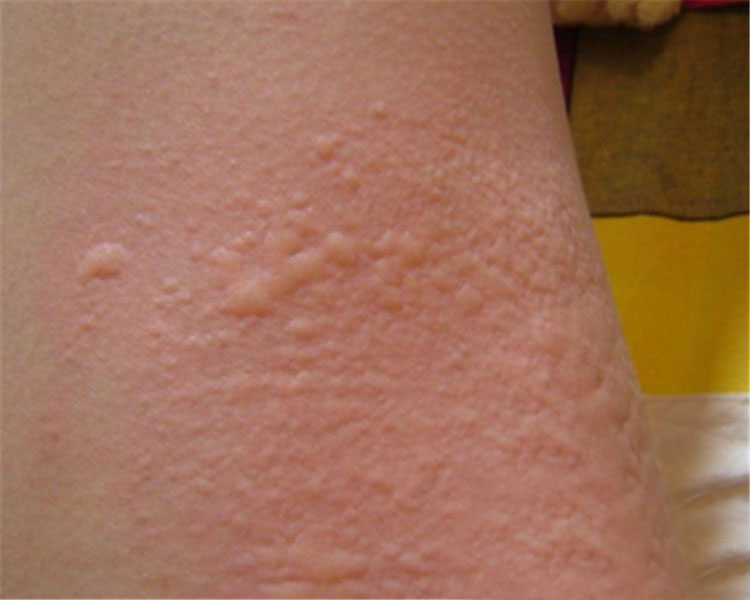 冷空气过敏荨麻疹图片图片