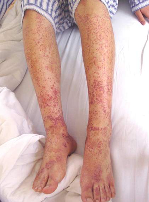 血清性荨麻疹症状图片图片