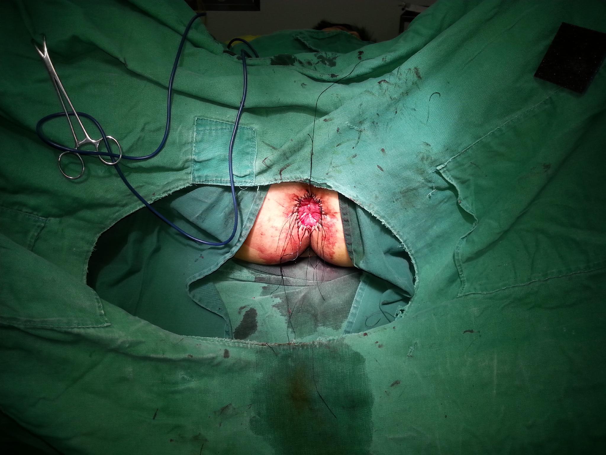 肛门疣手术创口图片