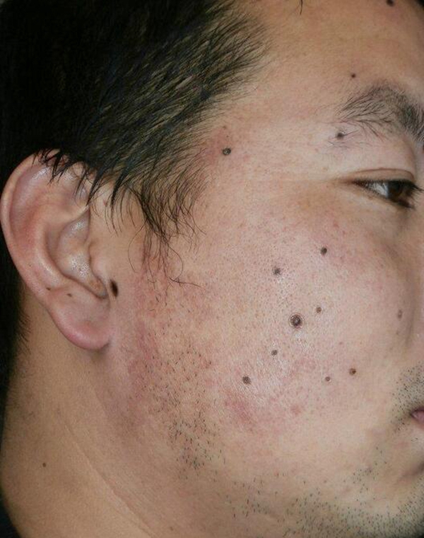 面部皮肤上的丝状疣晚期的图片