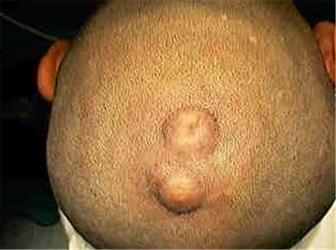 头皮纤维脂肪瘤图片