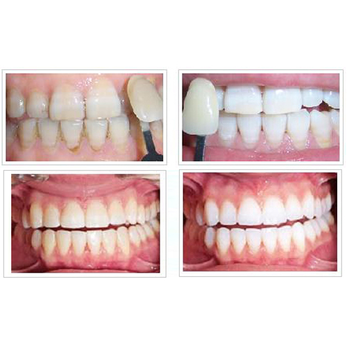 中度四环素牙治疗前后图片