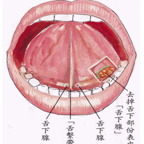 舌下腺囊肿如何治疗图片