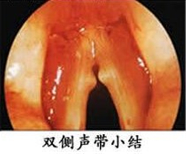 双侧声带小结图片