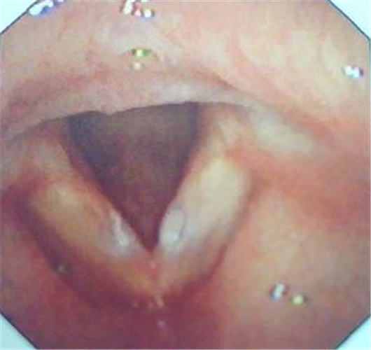 双侧声带小结的图片