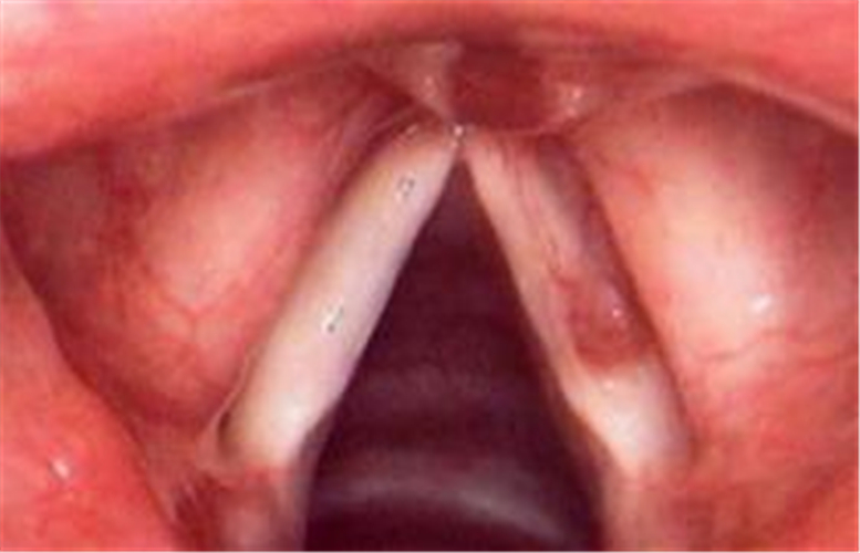 早期声带小结图片