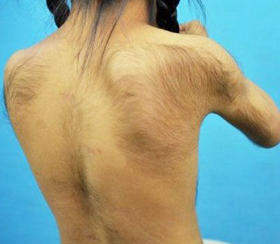 雄性激素增多引起多毛症背部图片