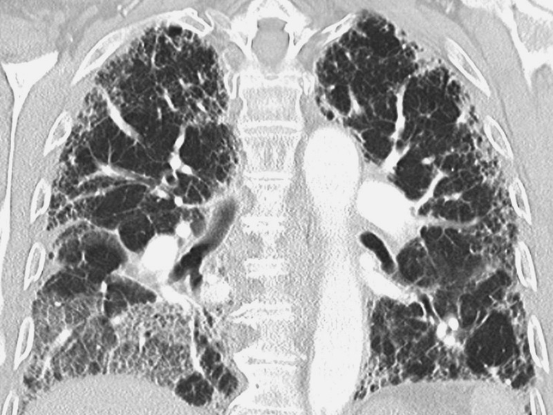 ＿肺纤维化彩超图片