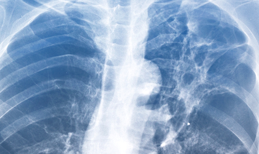 ＿肺纤维化的x线图片