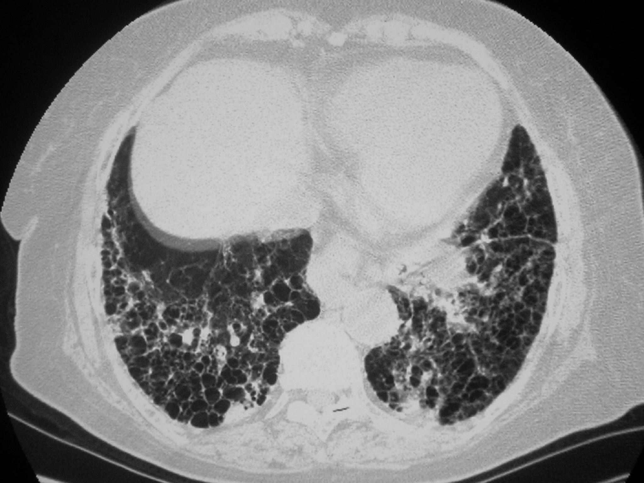 肺纤维灶图片