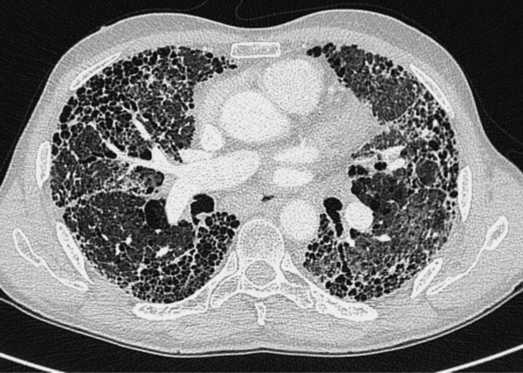 _左下肺肺纤维化病灶图片_有来医生