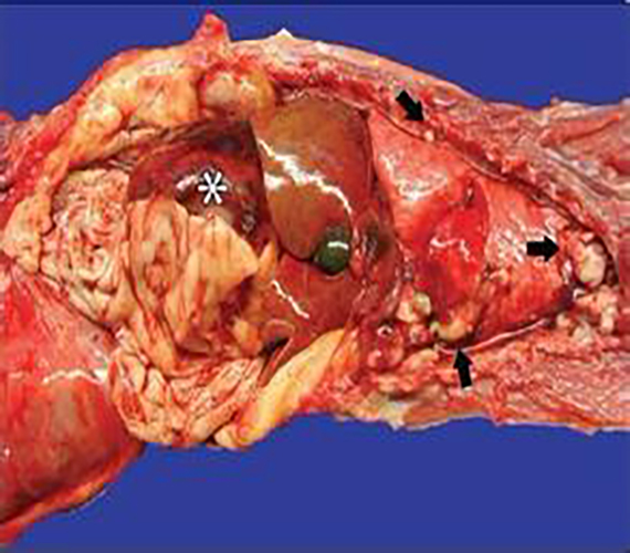 滑膜肉瘤病理图片