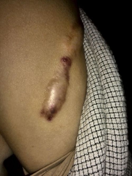 变性手术伤疤图图片