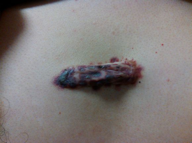 变性手术疤痕图片