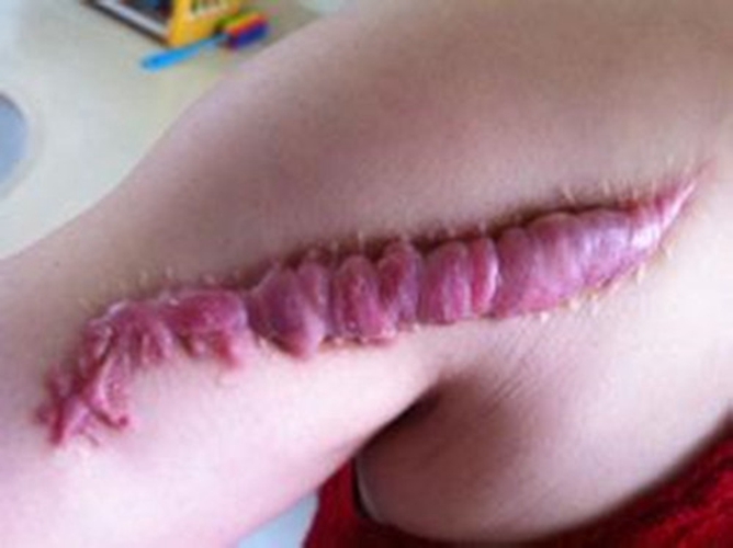 变性手术伤疤图图片