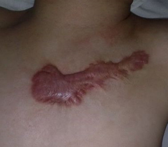 变性手术疤痕图片