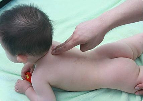 小孩痉挛性斜颈怎么治疗的图片