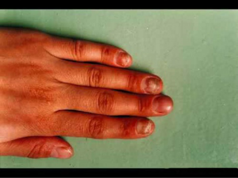 指尖皮肤念珠菌病图片