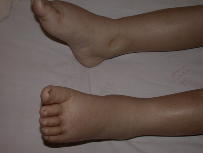 糖尿病腿 早期图片
