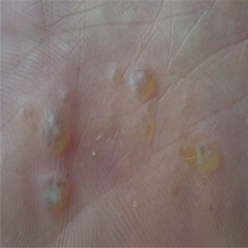 水泡足藓初期症状图片图片