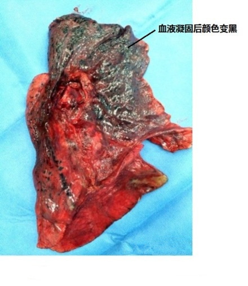 肺腺癌肿瘤图片