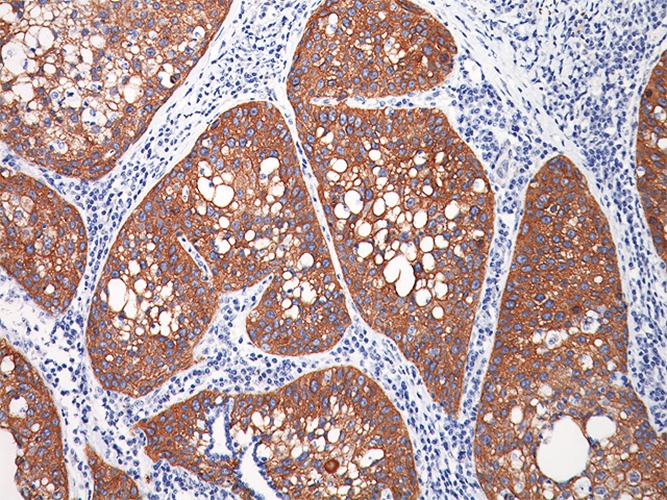 高分化肺腺癌切片图片