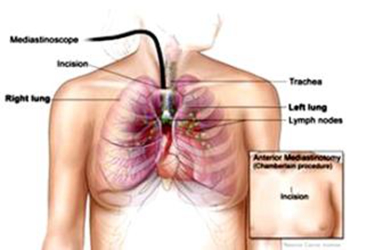 女性肺腺癌患者的临床症状图片