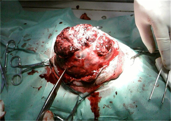 乳腺肿瘤切除术图片