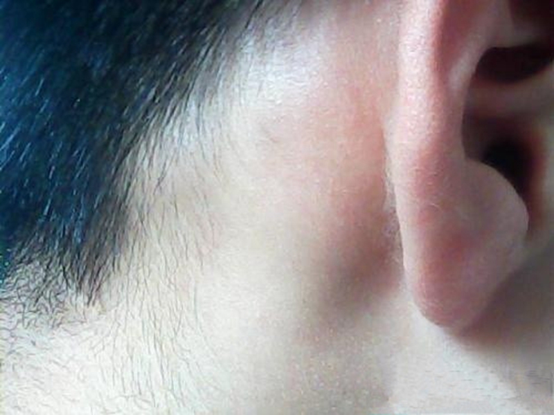 耳前淋巴癌早期症状图图片