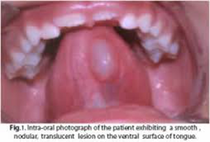  舌下腺囊肿穿刺过程图片