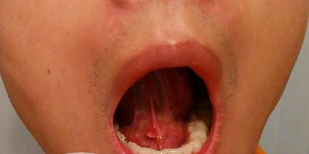  舌下腺囊肿初期的图片