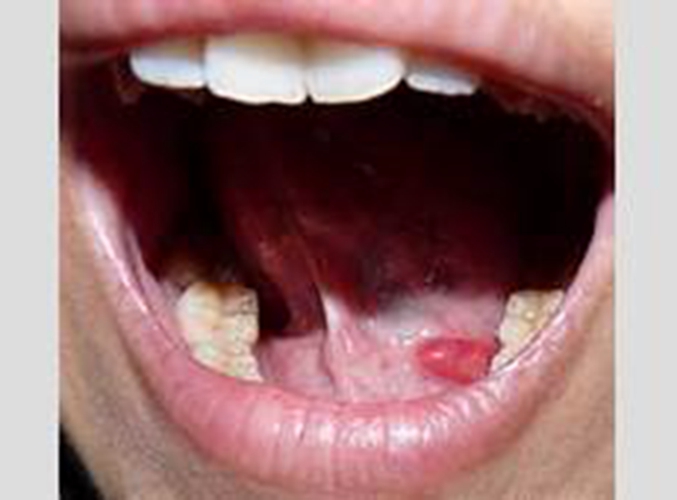  舌下腺囊肿喘气图片