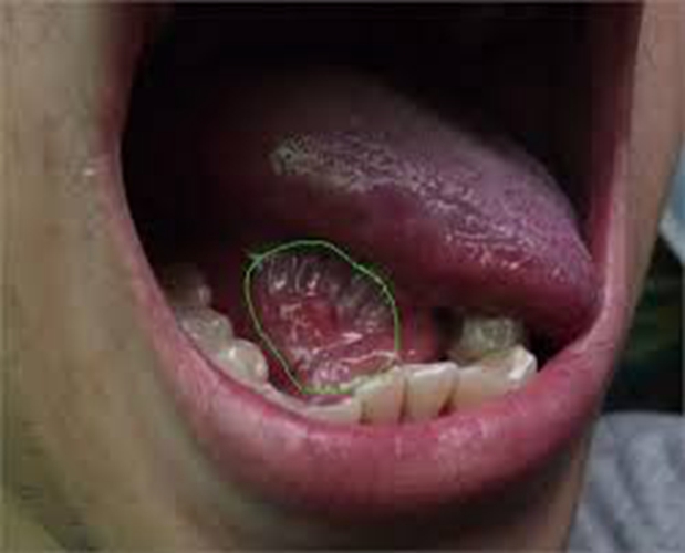  舌下腺囊肿的临床表现图片