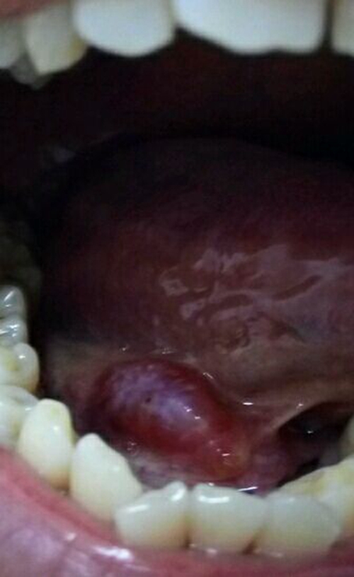  舌下腺囊肿发炎症状图片