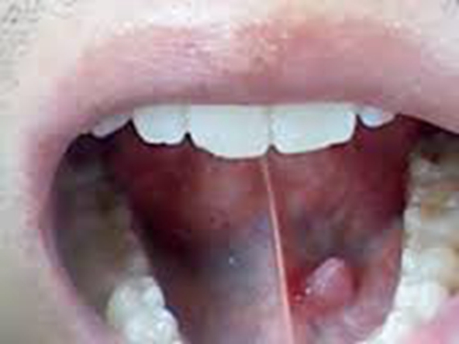  舌下腺囊肿和淋巴肿大图片