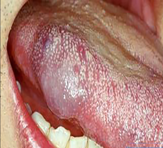 肠癌舌头症状图片图片