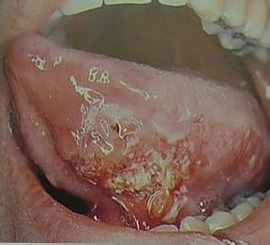 舌癌图片