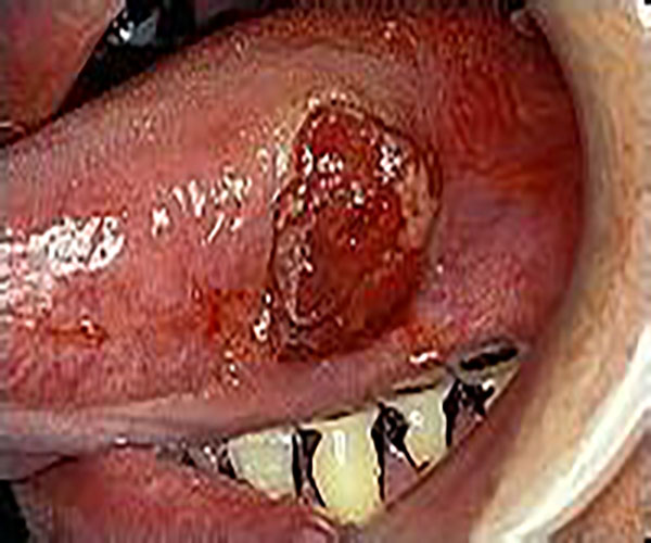 晚期图片舌癌图片舌癌早期症状舌癌手术图片舌癌舌头上头颈肿瘤图片