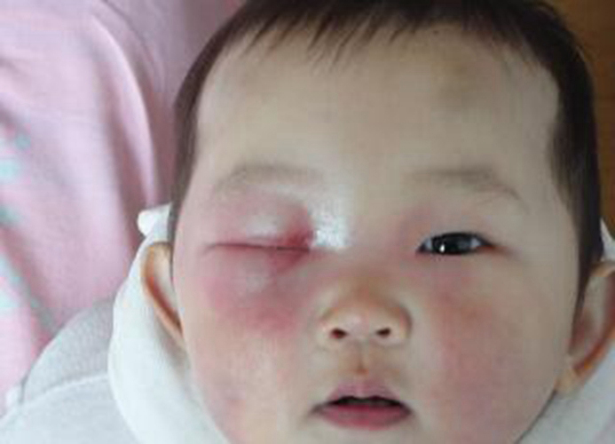 宝宝过敏性结膜炎红肿症状图片