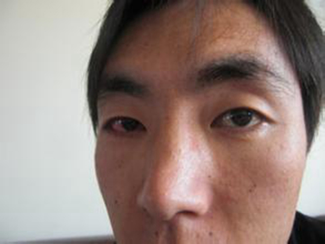 男性右眼过敏性结膜炎症状图片