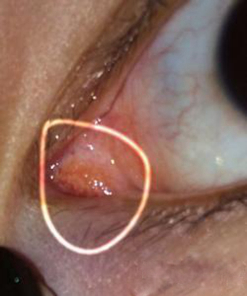 过敏性结膜炎眼角早期症状图片
