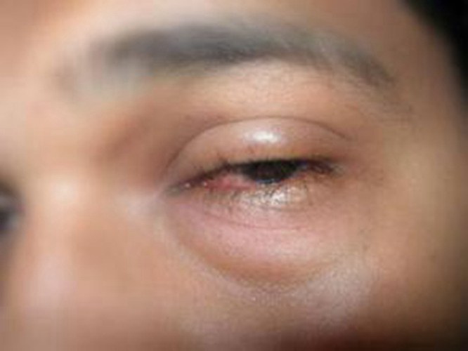 过敏性结膜炎眼睛肿胀图片