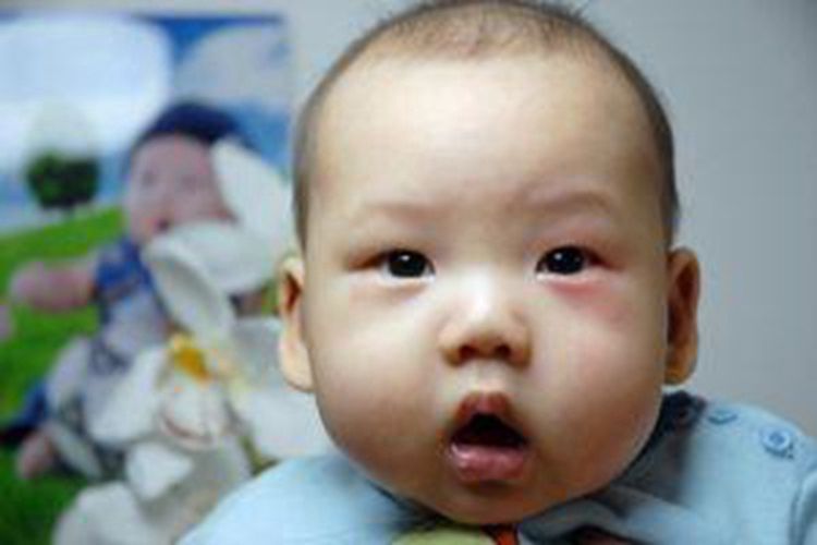 婴幼儿过敏性结膜炎图片