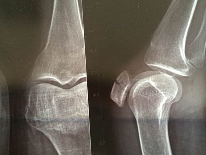 膝盖骨折图片 片子图片