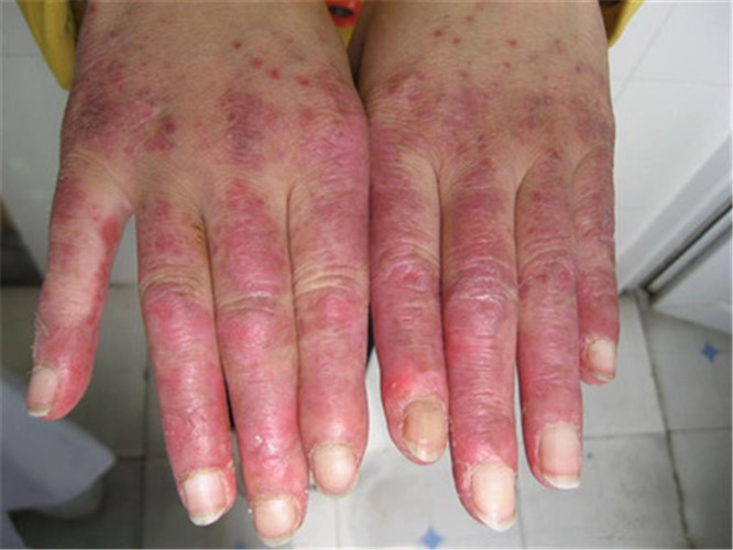 红斑狼疮早期手腕症状图片