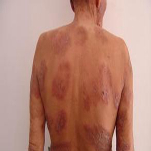 麻风病引起背部皮肤病变的图片