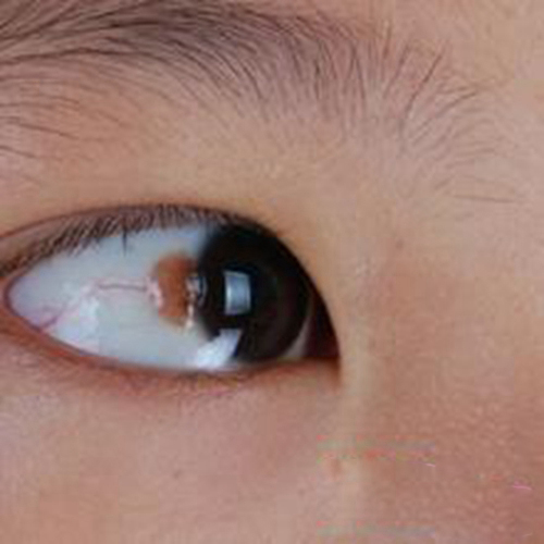 小孩眼底黄斑病变图片图片